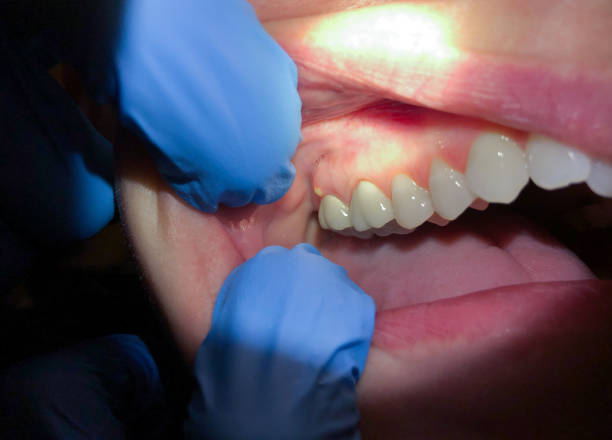Best Walk-In Emergency Dental Services in Benson, NC