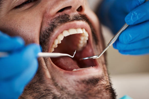 Best Emergency Wisdom Tooth Extraction in Benson, NC